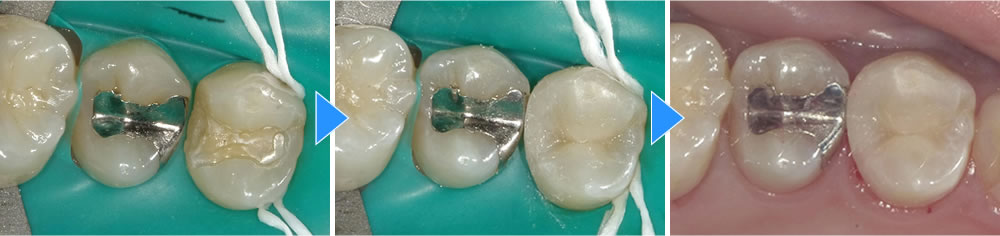 つめ物が取れた歯をダイレクトボンディングで修復した症例