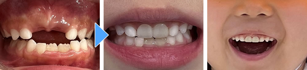 子供の前歯仮歯